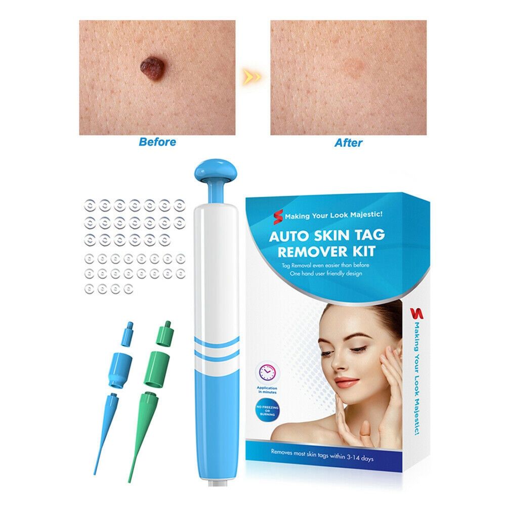 Skin tag  Removal Kit